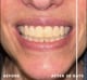 Pro Whitening Gel